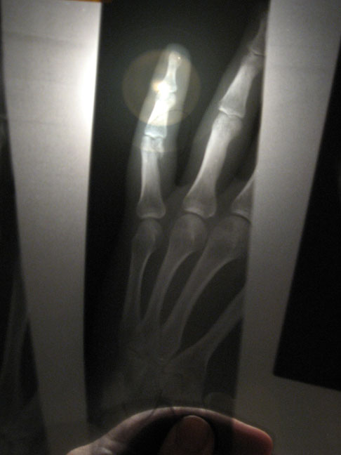 Broken Finger